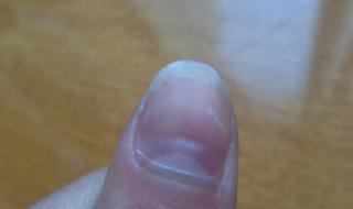 指甲盖上有黑色竖纹是什么原因 手指甲上有黑色竖纹